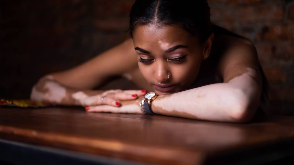 Photo of a young African American woman with vitiligo laying her head on her arms. Learn to control your anxious thoughts with the help of anxiety therapy in Atlanta, GA.
