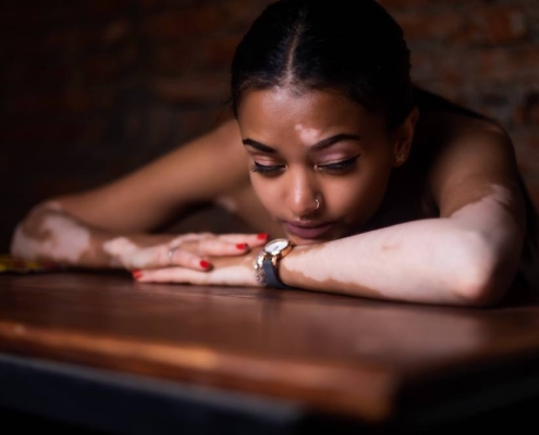 Photo of a young African American woman with vitiligo laying her head on her arms. Learn to control your anxious thoughts with the help of anxiety therapy in Atlanta, GA.